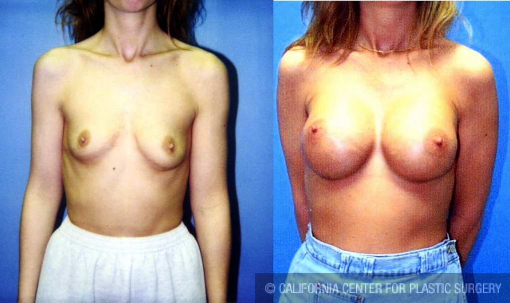 Breast Augmentation Before & After Patient #6415