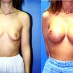 Breast Augmentation Before & After Patient #6415