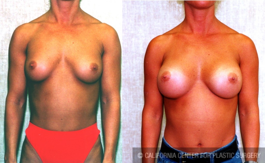 Breast Augmentation Before & After Patient #6271