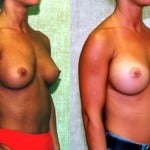 Breast Augmentation Before & After Patient #6271