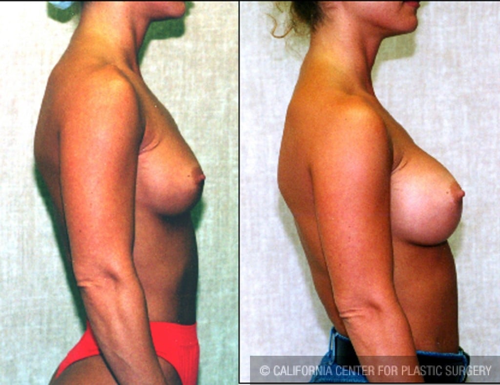 Breast Augmentation Before & After Patient #6271