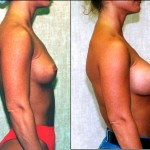 Breast Augmentation Before & After Patient #6271