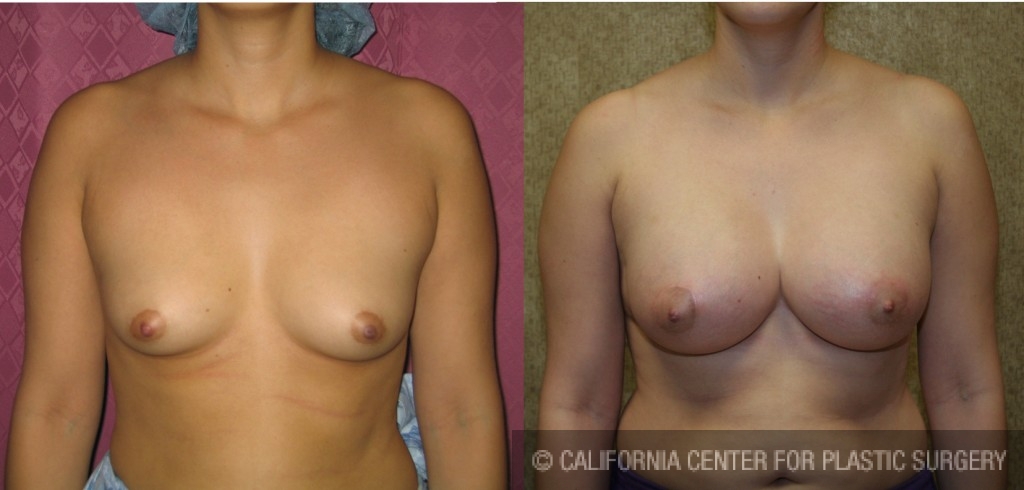 Breast Augmentation Before & After Patient #6425