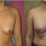 Breast Augmentation Before & After Patient #6425