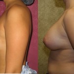 Breast Augmentation Before & After Patient #6425