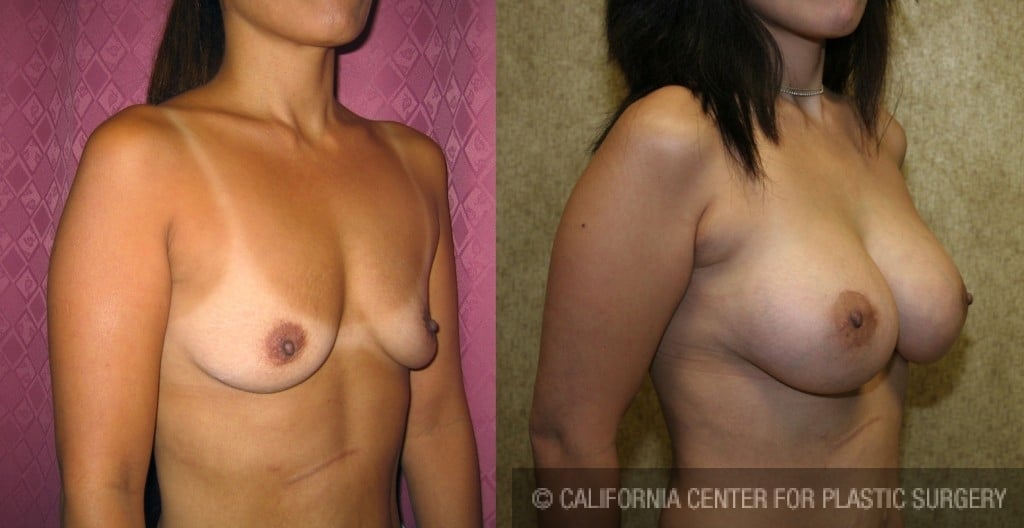 Breast Augmentation Before & After Patient #6256