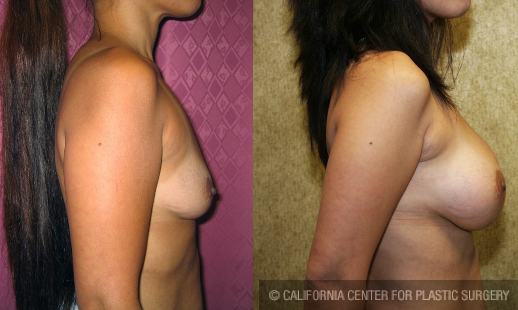 Breast Augmentation Before & After Patient #6256
