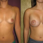 Breast Augmentation Before & After Patient #6276