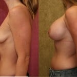 Breast Augmentation Before & After Patient #6318