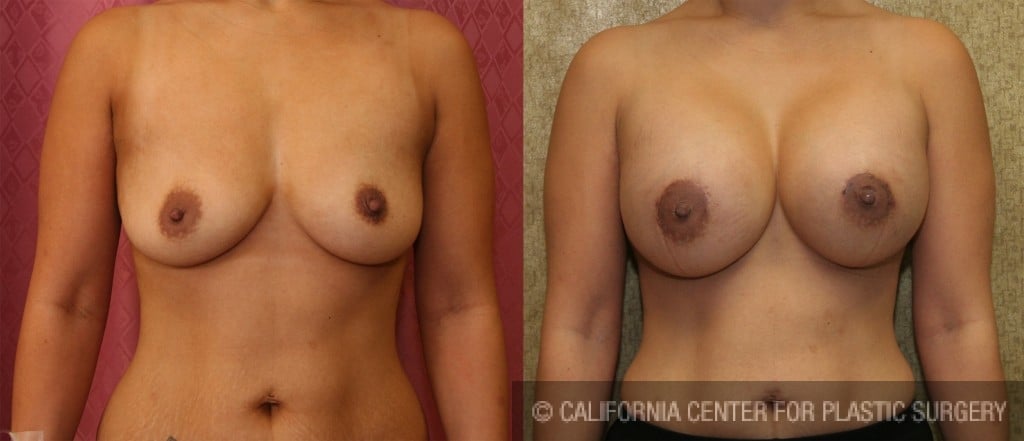 Breast Augmentation Before & After Patient #6448