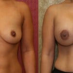 Breast Augmentation Before & After Patient #6448