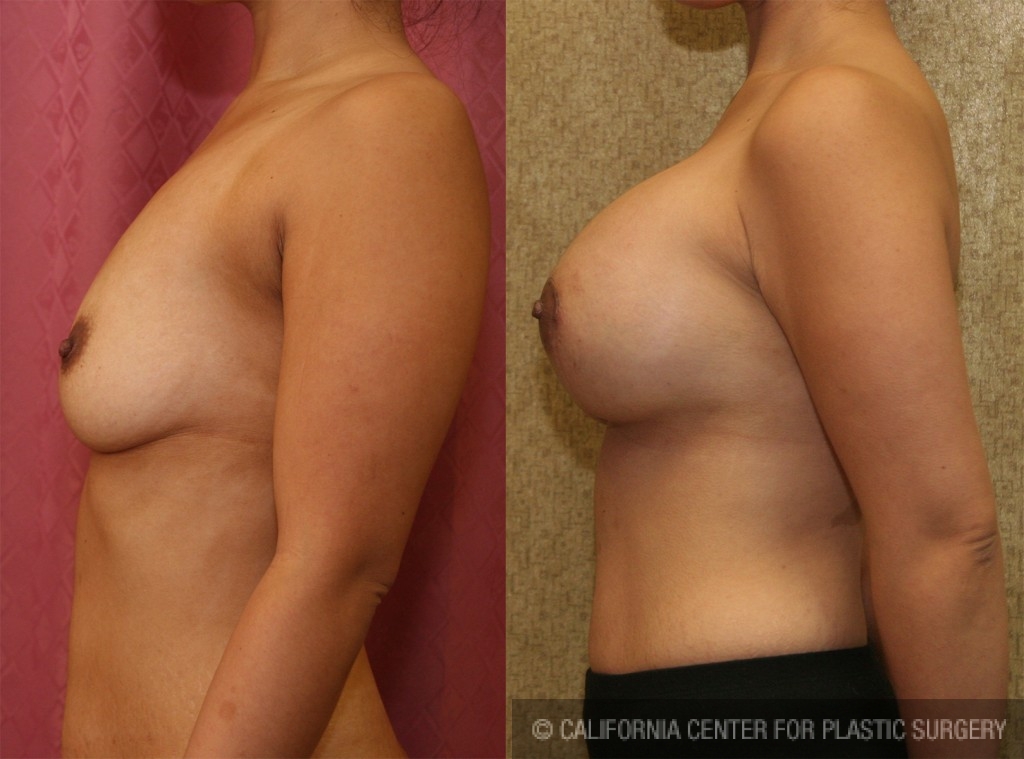 Breast Augmentation Before & After Patient #6448