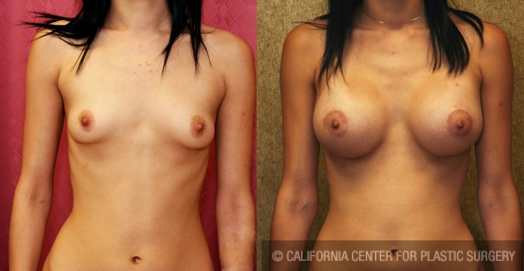 Breast Augmentation Before & After Patient #6308