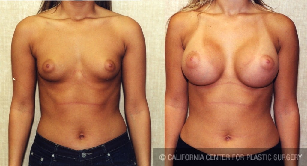 Patient #6285 Breast Augmentation Before and After Photos Encino