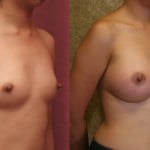 Breast Augmentation Before & After Patient #6395