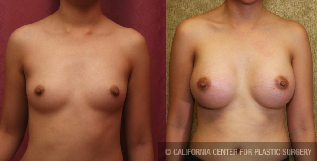 Breast Augmentation Before & After Patient #6395