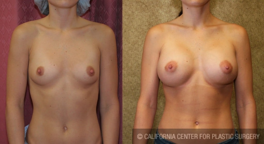 Breast Augmentation Before & After Patient #6213