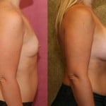 Breast Augmentation Before & After Patient #6351