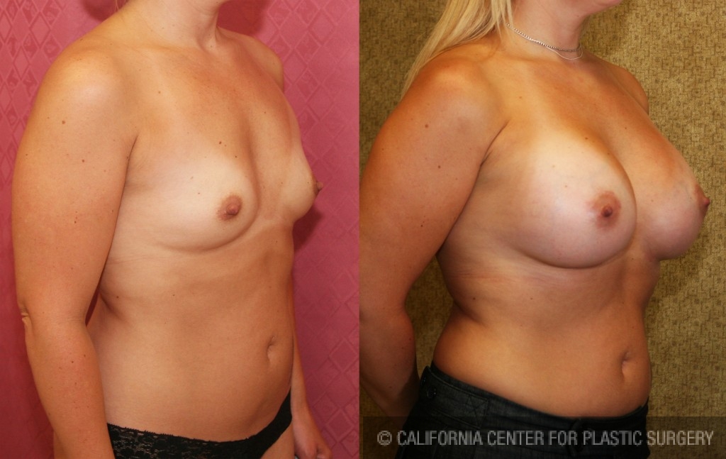 Breast Augmentation Before & After Patient #6351