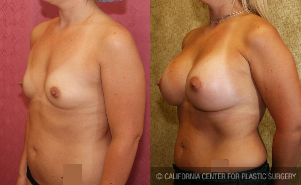 Breast Augmentation Before & After Patient #6351