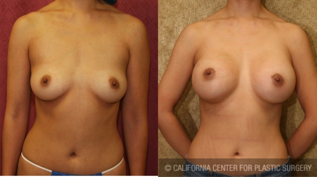 Breast Augmentation Before & After Patient #6359