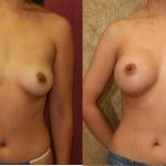 Breast Augmentation Before & After Patient #6359