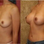 Breast Augmentation Before & After Patient #6359