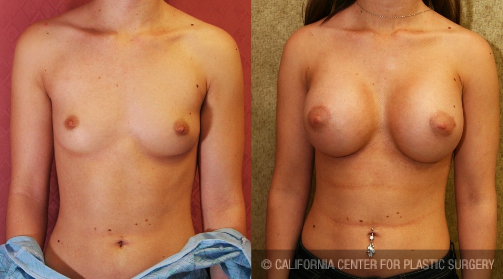 Breast Augmentation Before & After Patient #6219