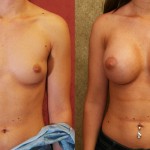 Breast Augmentation Before & After Patient #6455