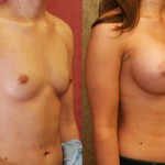 Breast Augmentation Before & After Patient #6219