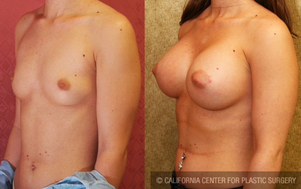 Breast Augmentation Before & After Patient #6219