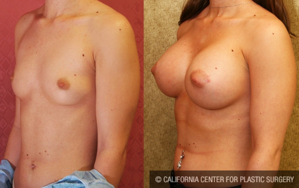 Breast Augmentation Before & After Patient #6395