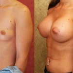 Breast Augmentation Before & After Patient #6455