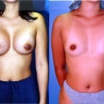 Breast Augmentation Before & After Patient #6367