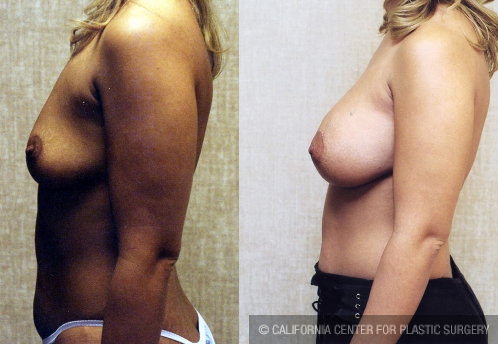 Breast Augmentation Before & After Patient #6335