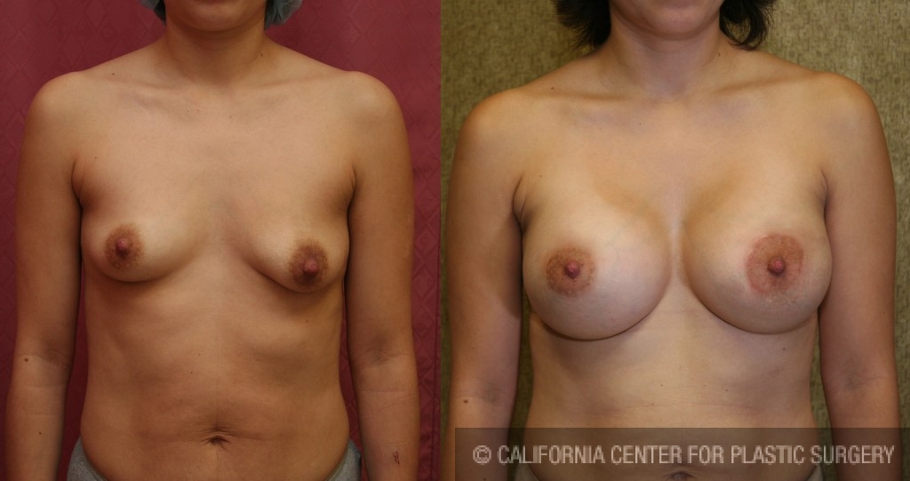 Breast Lift - Moderate Before & After Patient #6608