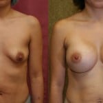 Breast Lift - Moderate Before & After Patient #6608