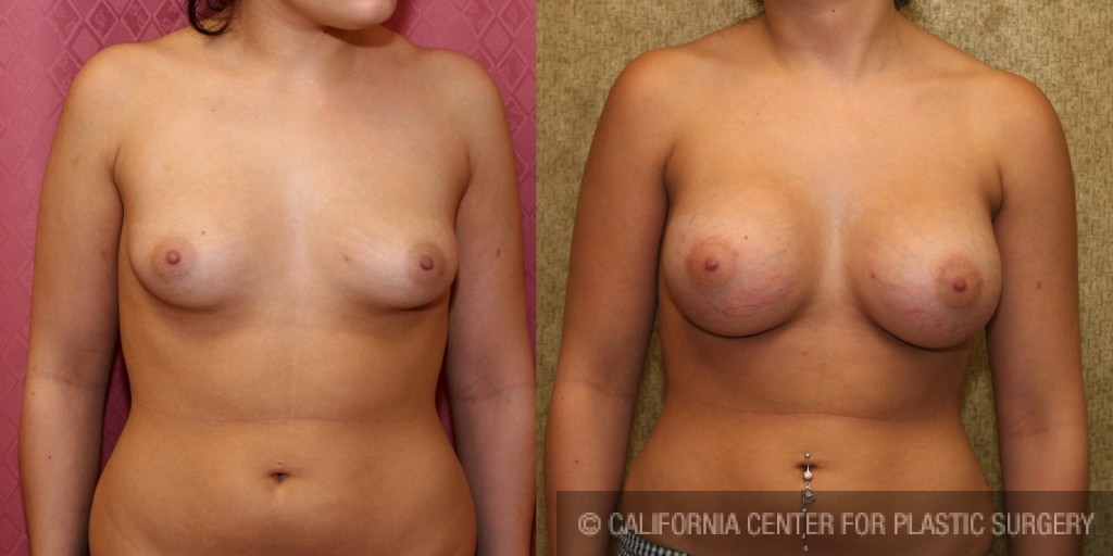 Breast Asymmetry Before & After Patient #6941