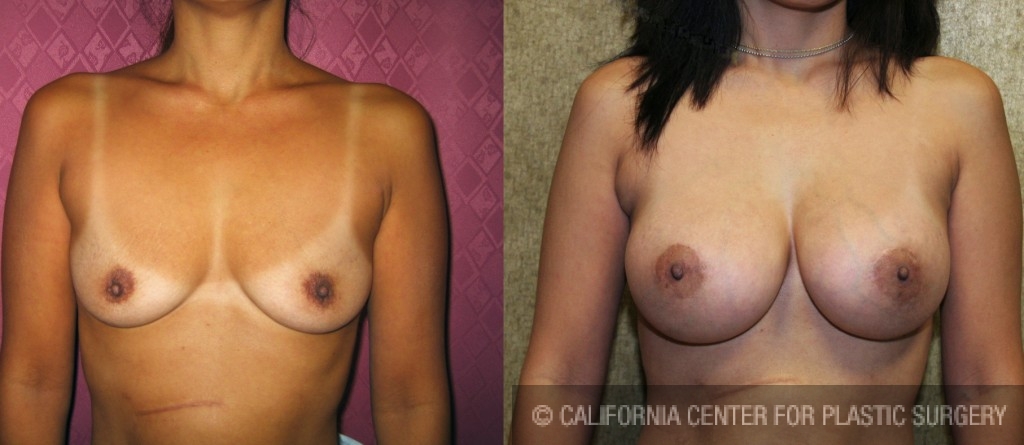 Breast Augmentation Before & After Patient #6256