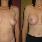 Breast Augmentation (Revision) Before & After Patient #6478
