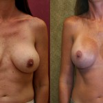 Breast Lift - Full Before & After Patient #6697