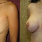 Breast Lift - Full Before & After Patient #6709