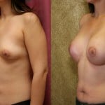 Breast Lift - Moderate Before & After Patient #6602