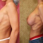 Breast Lift - Full Before & After Patient #6717