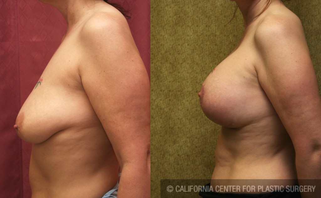 Breast Lift - Full Before & After Patient #6738