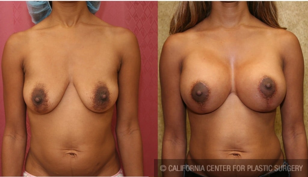 Breast Lift - Full Before & After Patient #6819