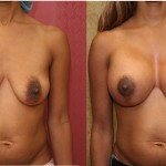 Breast Lift - Full Before & After Patient #6819