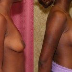 Breast Lift - Moderate Before & After Patient #6646