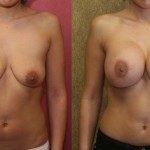 Breast Lift - Moderate Before & After Patient #6656