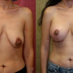 Breast Lift - Full Before & After Patient #6909